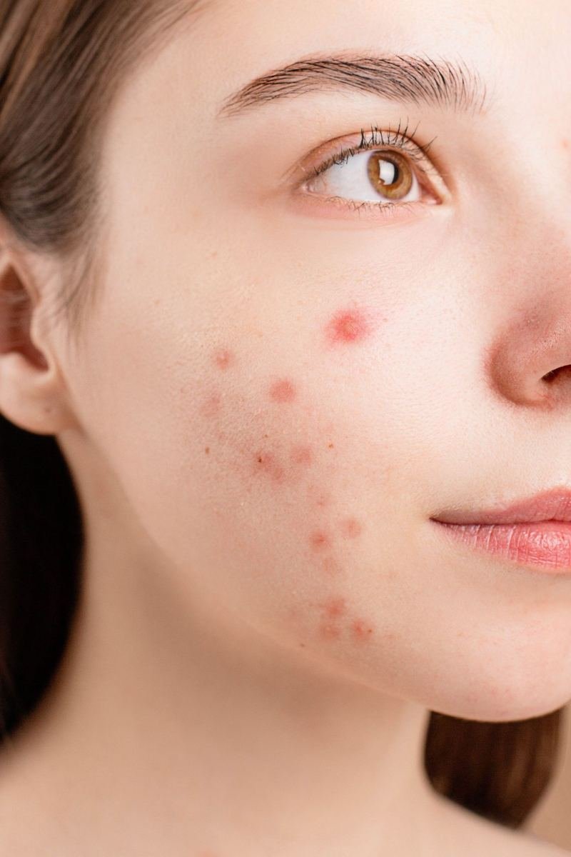 Rosto de mulher jovem com lesões de acne na bochecha