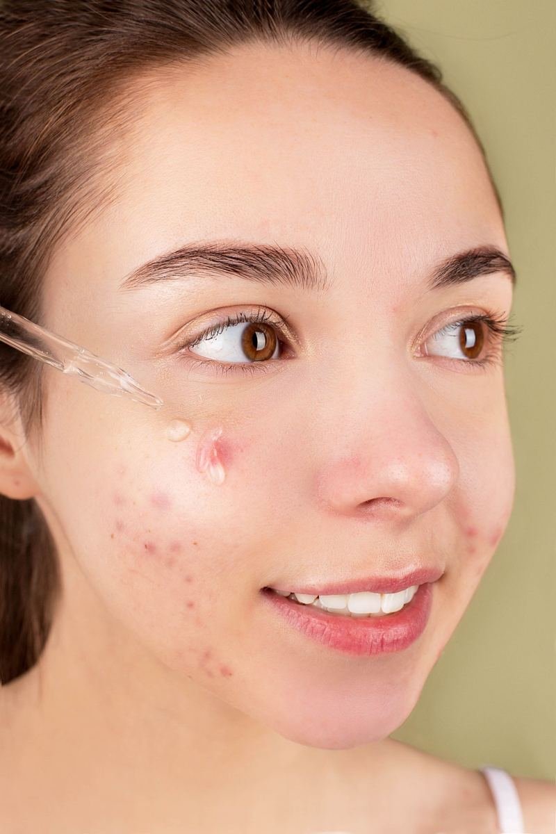 Mulher com acne aplicando cuidado no rosto